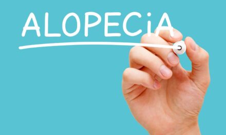 Alopecia Areata