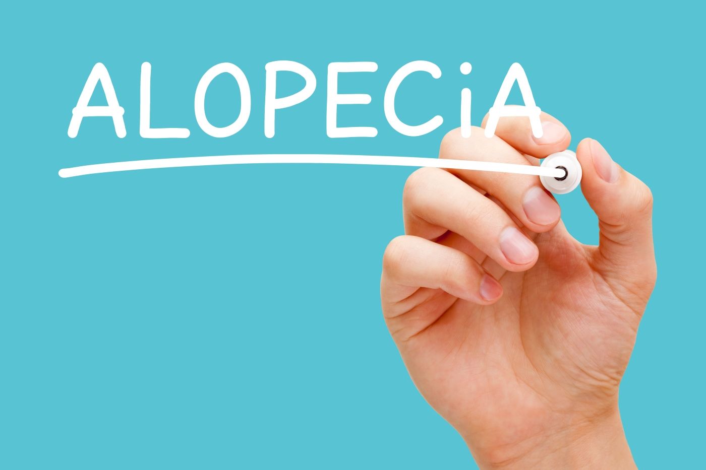 Alopecia Areata