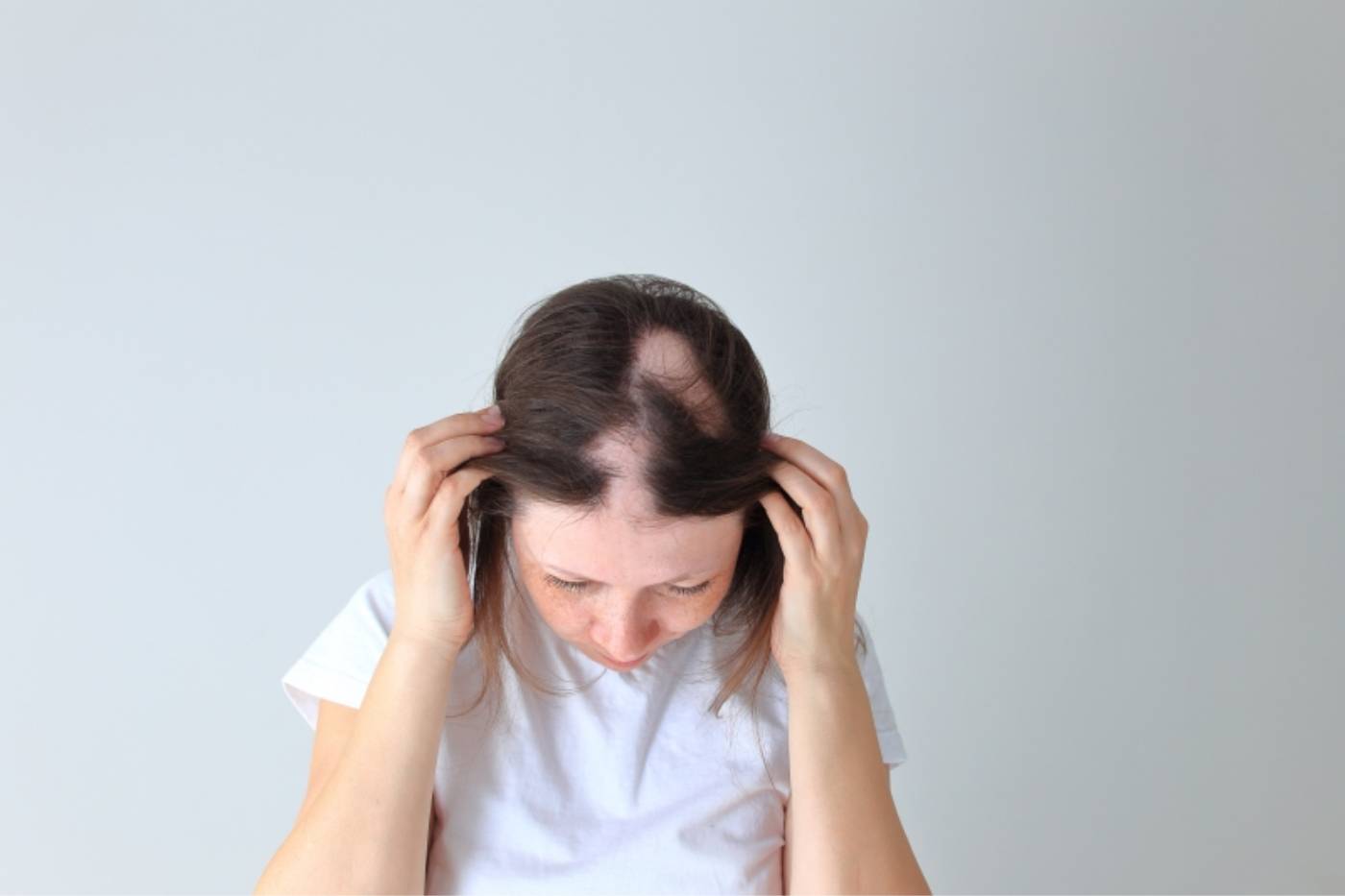 Chica con síntomas de alopecia areata